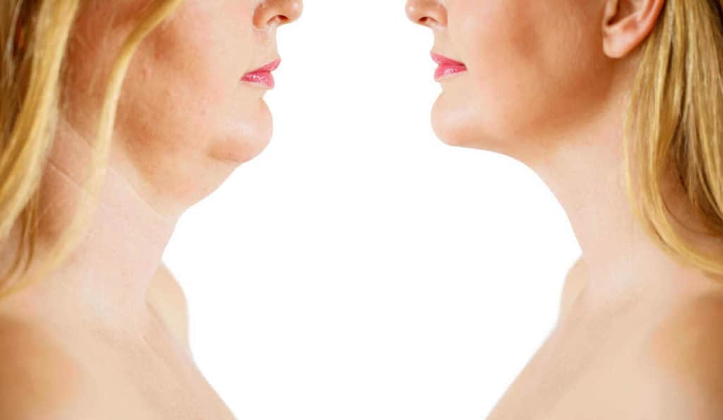 Double Chin treatment Apsley before and after results
