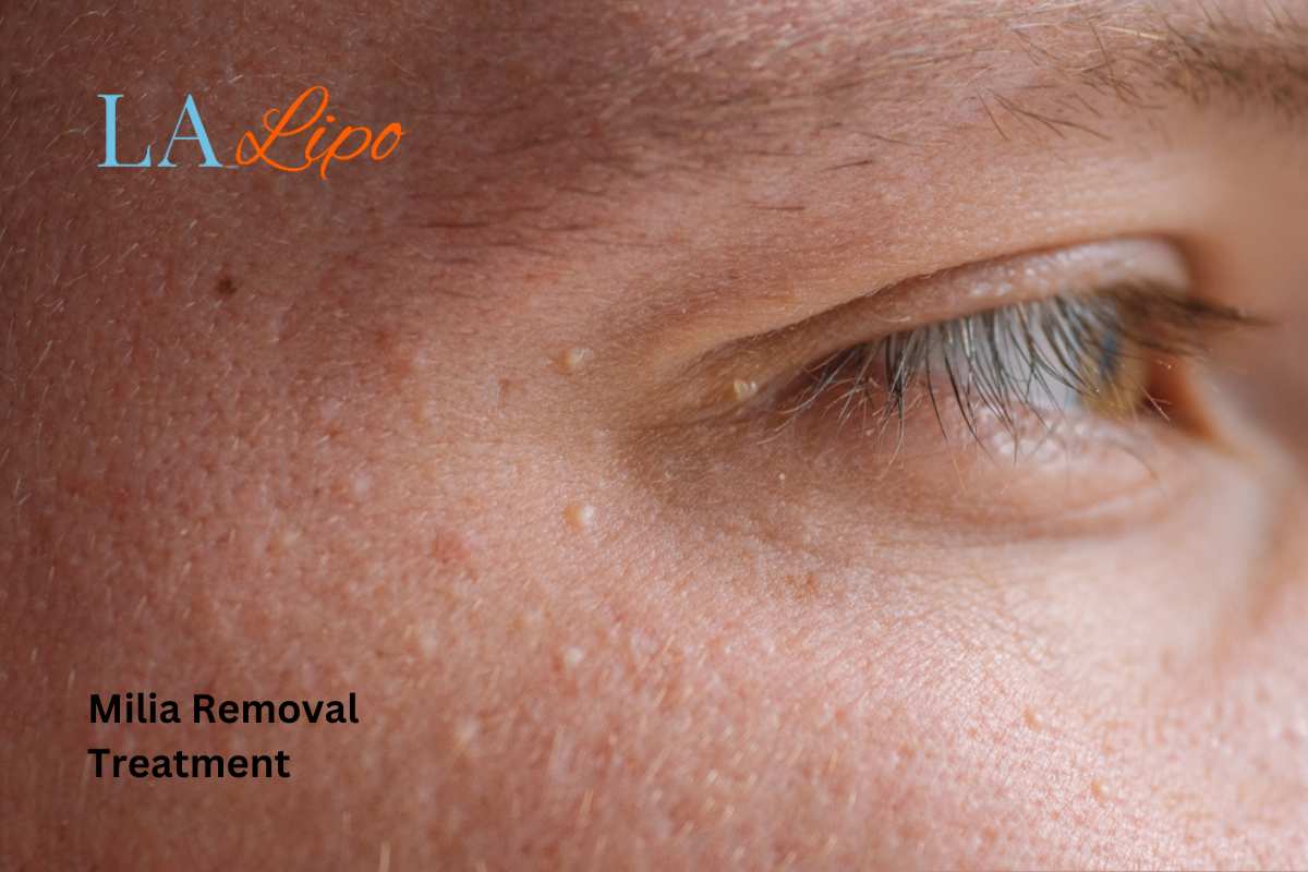 Cryopen Milia Removal: Is It the Easiest and Safest Option Apsley?