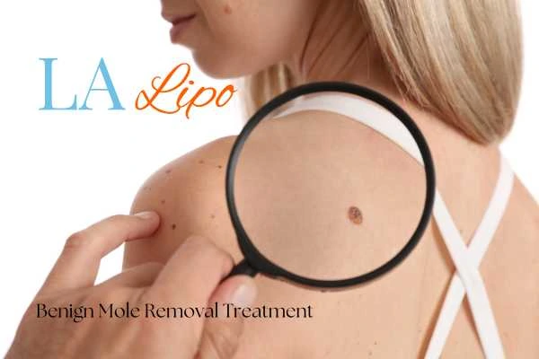 Woman having her inspection of blemish before mole removal Apsley