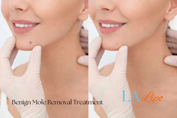 Before and after mole removal Apsley treatment