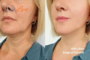 hi-fu for wrinkles Apsley before and after results