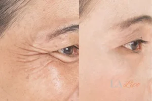 Before and after results of woman - HI-fu wrinkles reduction treatment Apsley