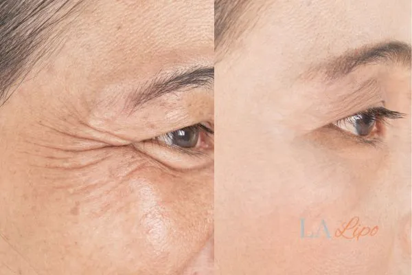Before and after results of woman - HI-fu wrinkles reduction treatment Apsley