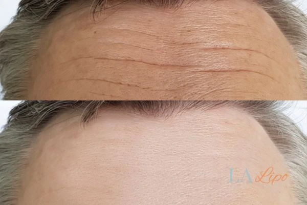 results of HIFU Apsley on mans forehead to help reduce lines and wrinkles
