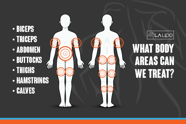 Graphic to show areas you can have LA-EMS Body Sculpting Apsley treatment.