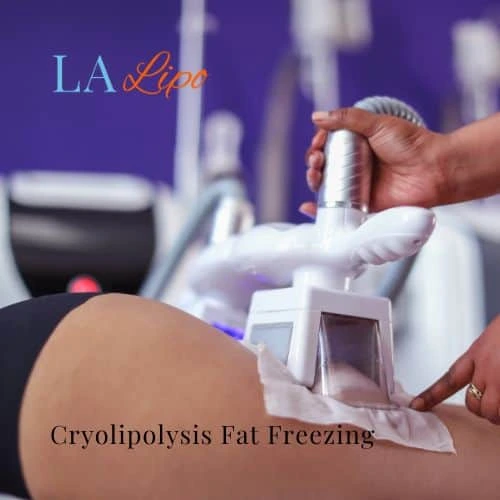 fat freezing - Cryolipolysis Apsley