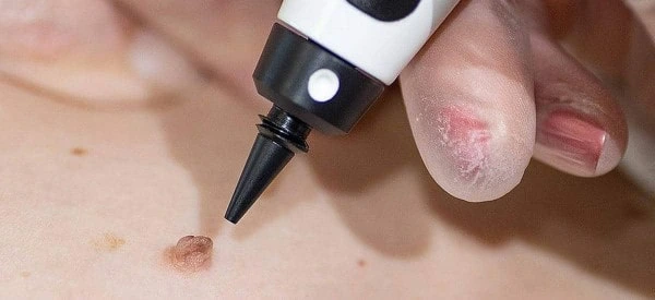 skin tag removal using cryopen Apsley