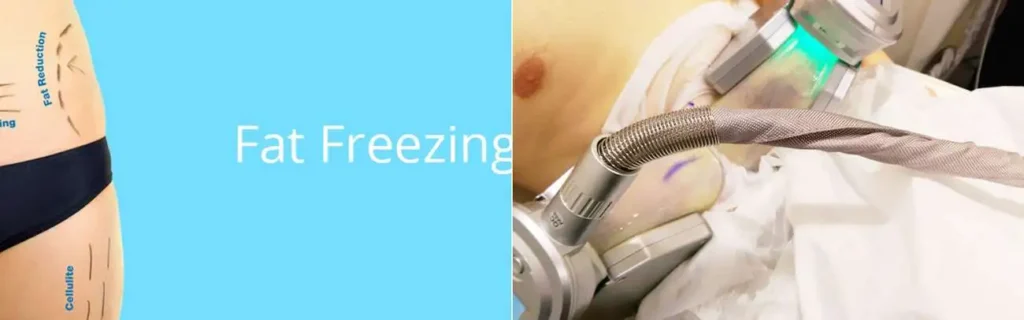 Fat freezing Apsley on multiple areas of the body