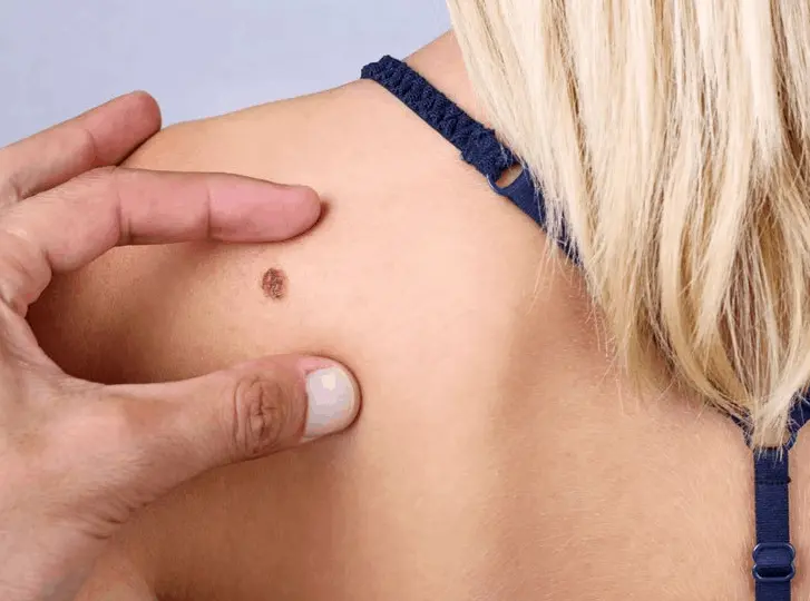 woman having mole removal Apsley consultation before treatment.