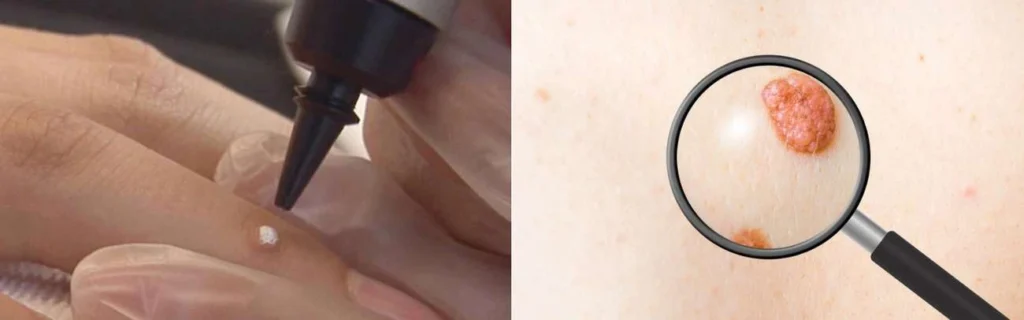 Person getting moles removed with cryopen Apsley