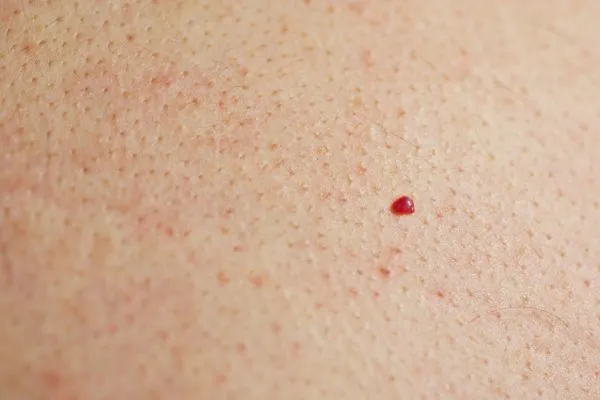 close up of a cherry angioma Apsley