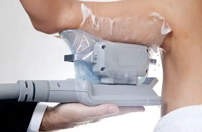 Picture of fat freezing Apsley on the upper arms.
