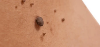 image of a skin tag Apsley