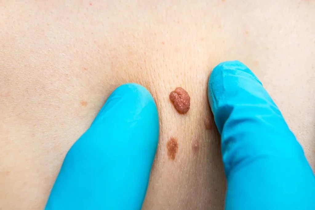 Consultant examining a skin tag Apsley