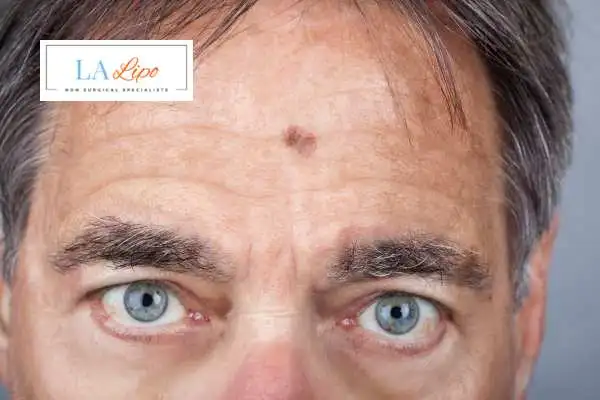 Solar Lentigo Removal Apsley image of man with mark on his forehead