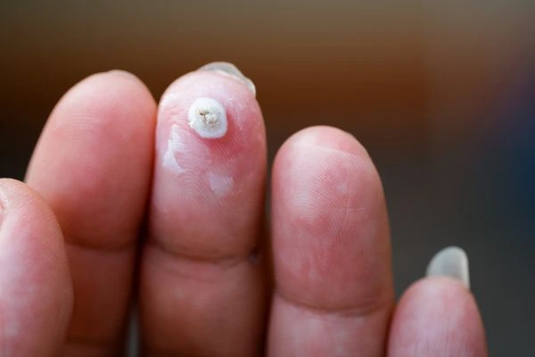 wart on person finger - cryotherapy to treat from LA LIPO Apsley