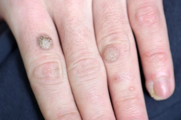 photo of warts on person hand - see wart removal Apsley from LA LIPO