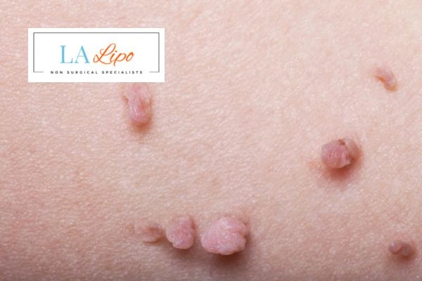 Does cryopen skin tag removal Apsley hurt? Find out now call our team today!