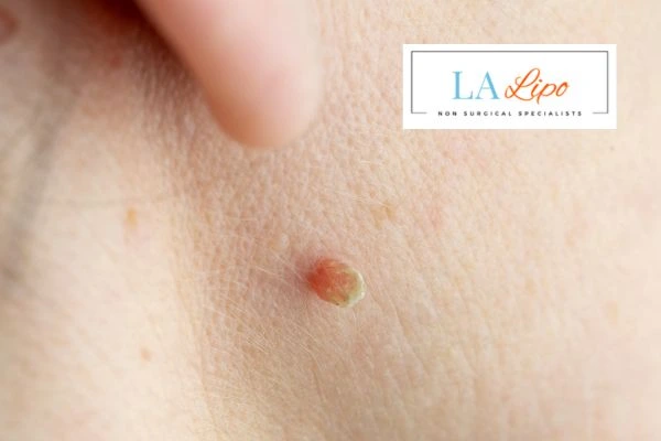 Book skin tag removal Apsley today speak to our team now!