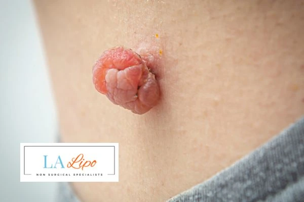 Interested in skin tag removal Apsley? Concerned about the pain? Find out more today!