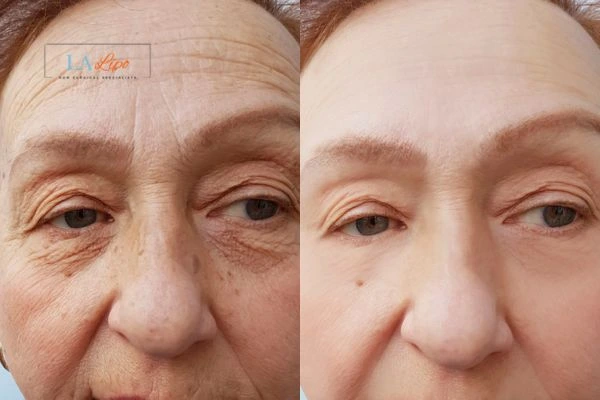 The powerful benefits of Morpheus8 Treatment Apsley - Call Our team today!