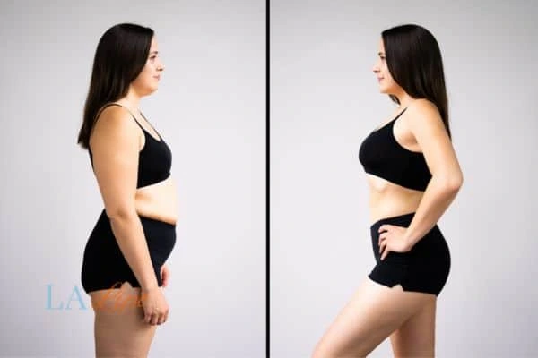 Picture of womans before and after using LA-EMS body sculpting to improve her core strength Apsley