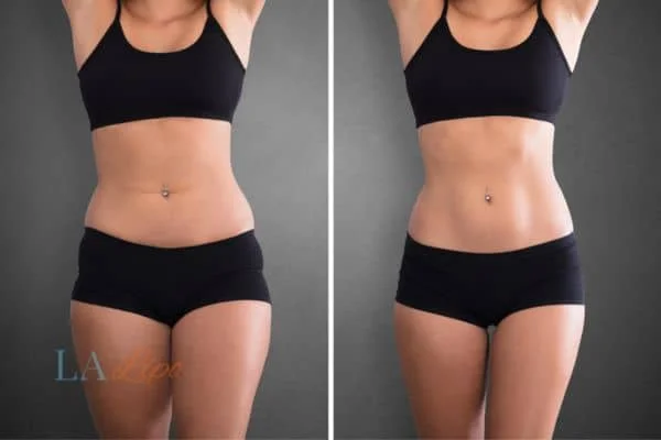 before and after results of non-surgical treatment to help a woman's body image and mental health Apsley