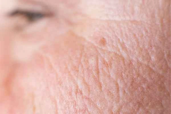 close up picture of a woman's face showing an age spot Apsley