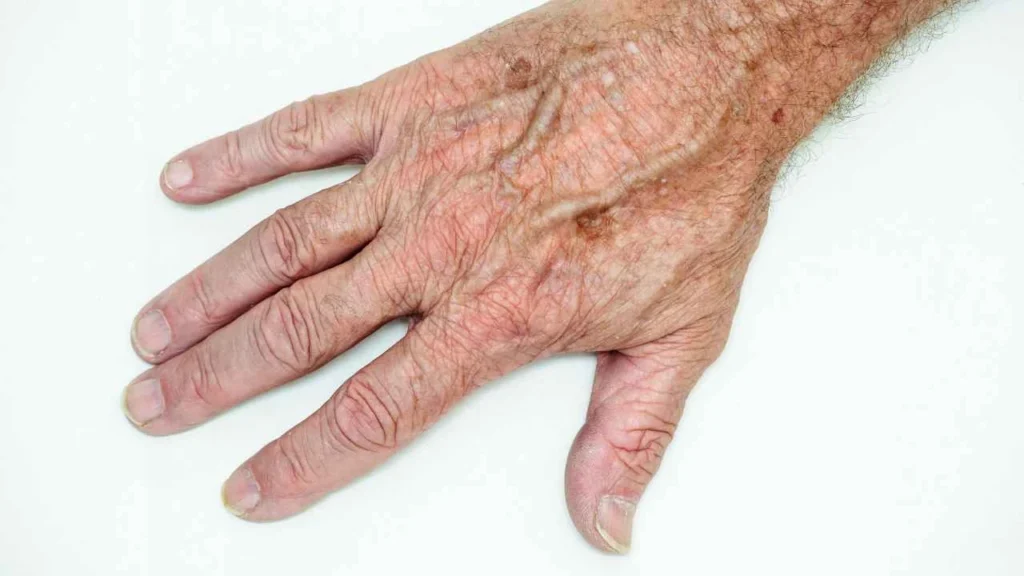 Male hand showing age spot Apsley