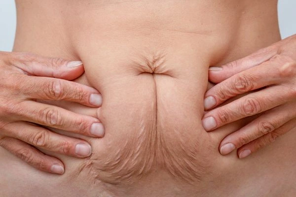 Image of a woman's stomach with loose skin - example of skin tightening Apsley options