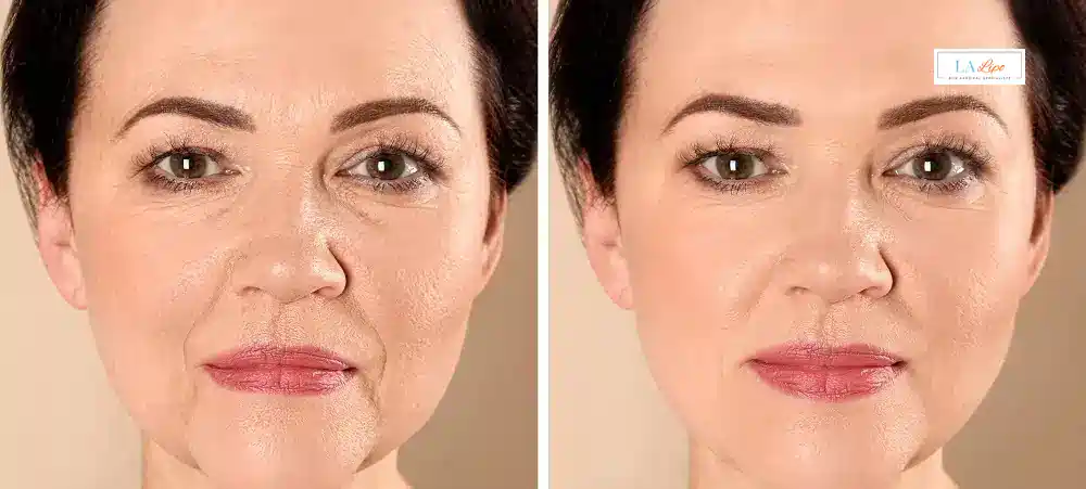 How Long Does It Take to See Results and How Long Do They Last Apsley?