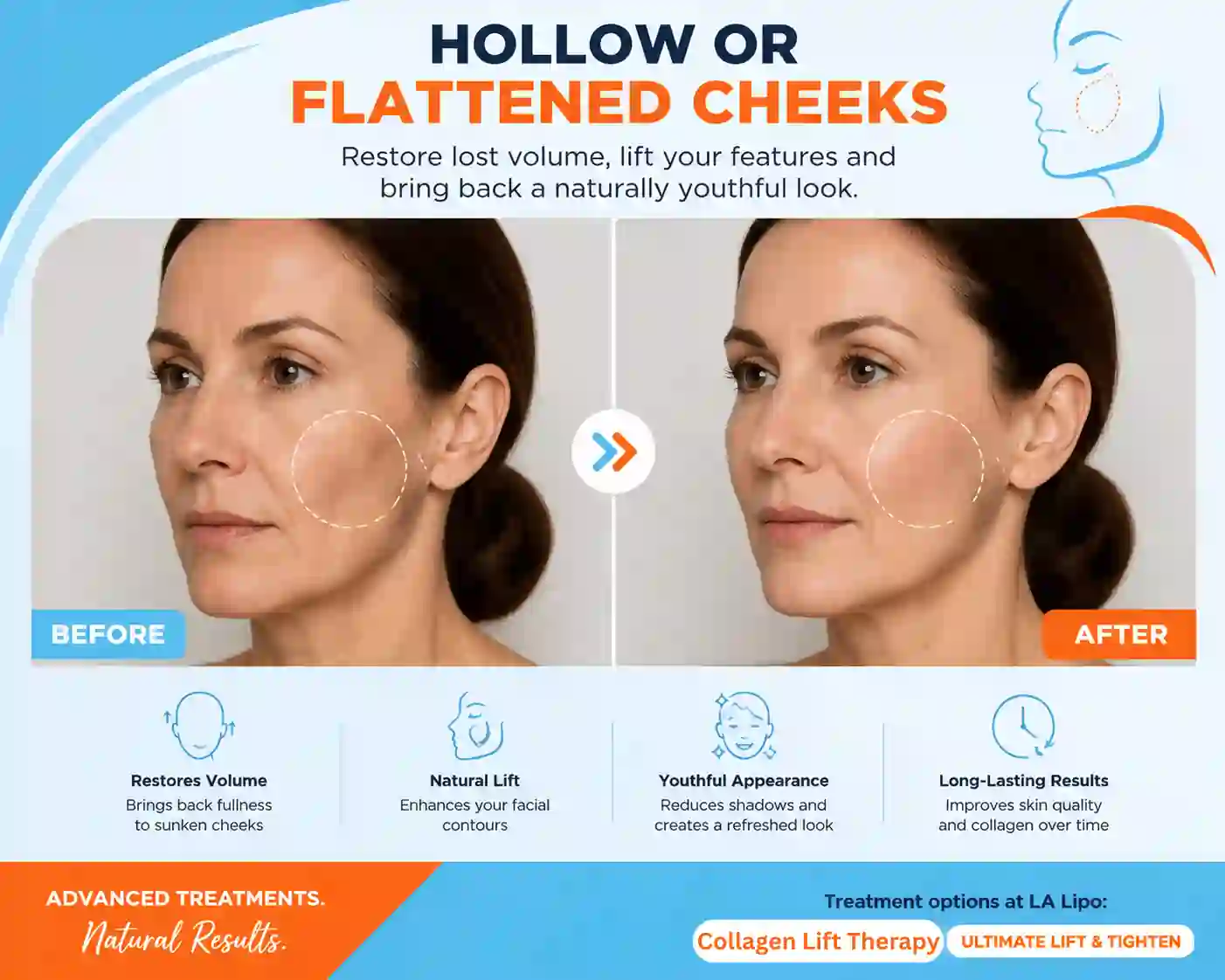 Sign #4: Hollow or Flattened Cheeks Apsley