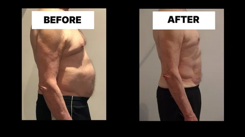 What Symptoms Can Diastasis Recti Cause in Men? Weak Core, Back Pain and Poor Posture Apsley